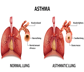 Drug Combo Albuterol-Budesonide Reduces Risk of Asthma Attacks